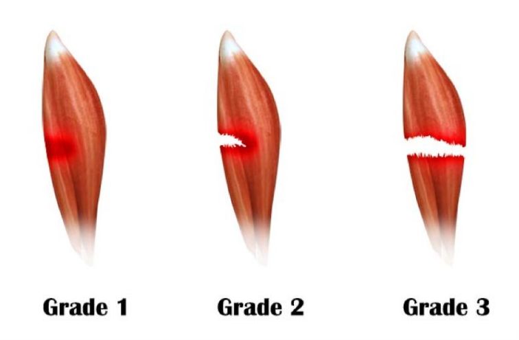 跑步肌肉拉伤怎么办,以下几点要注意!