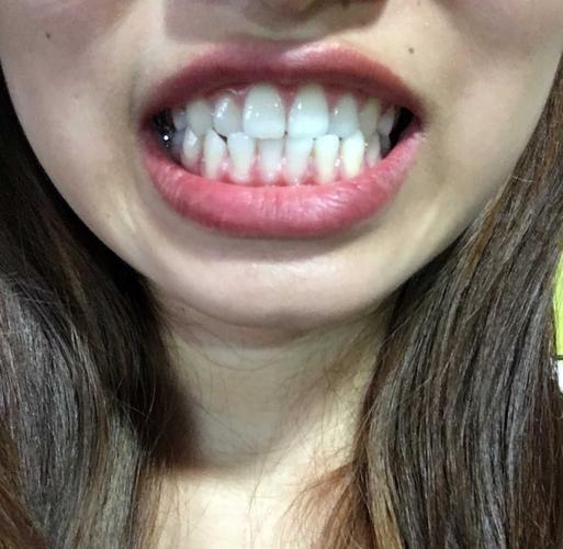 牙齿对刃,有必要矫正吗?