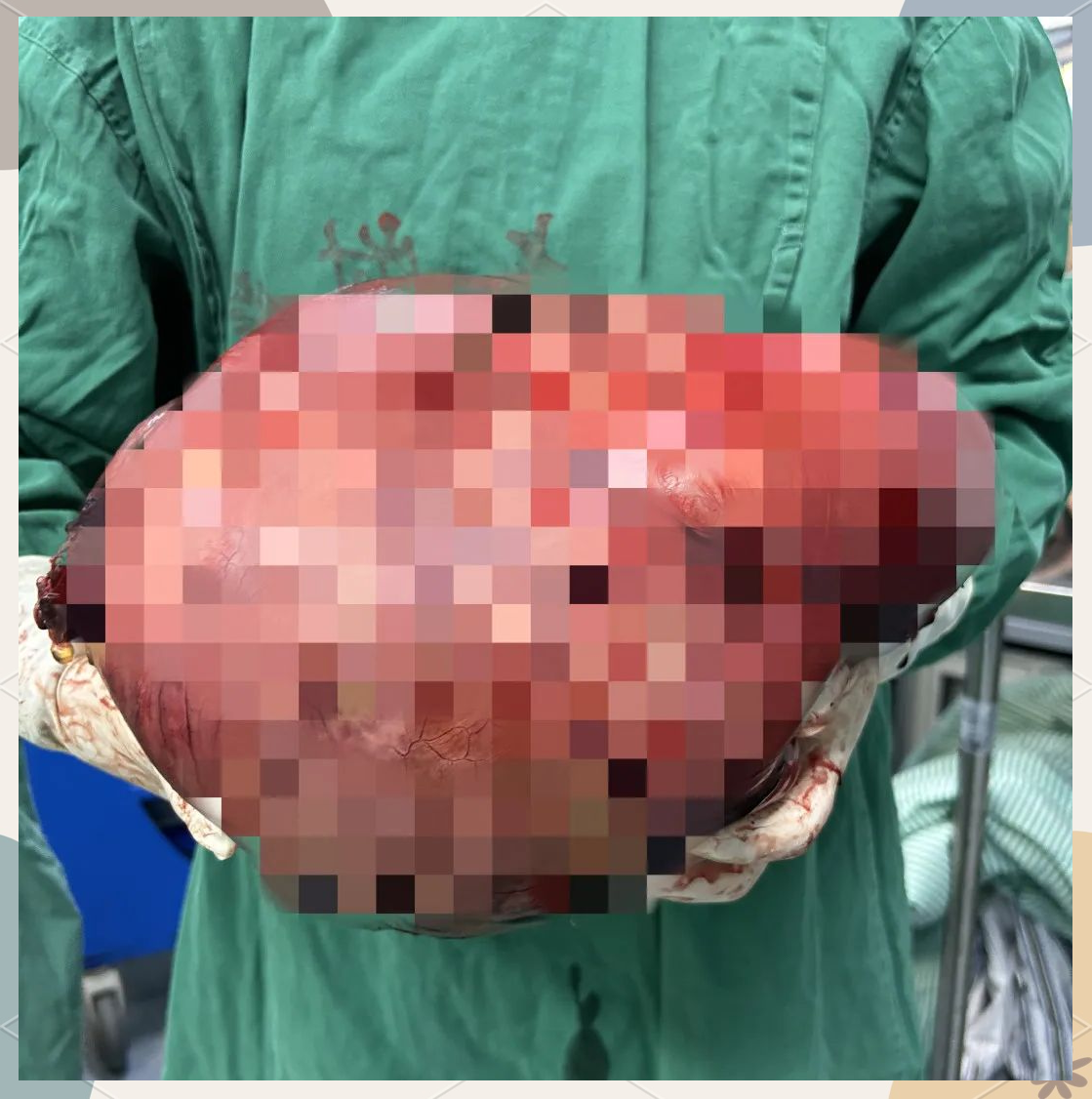 刘颖成功切除体内巨瘤:腹膜后肿瘤治疗的多学科协作