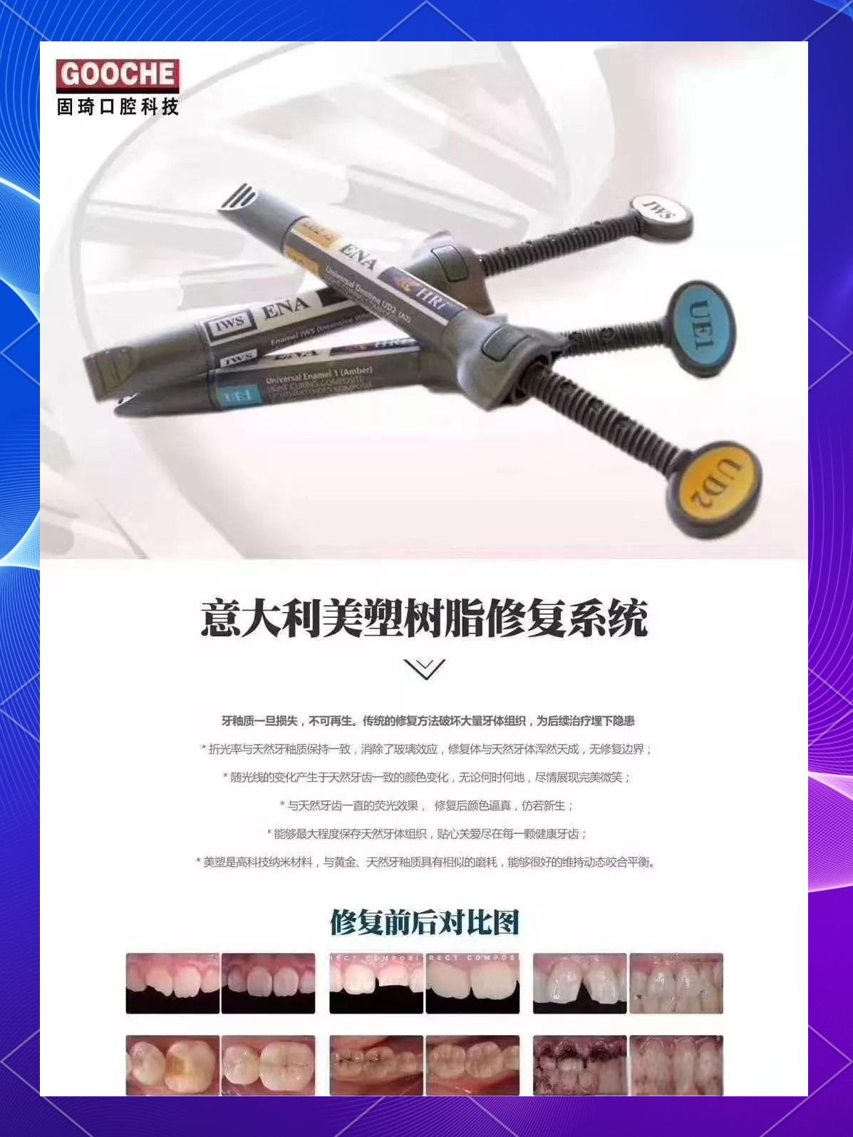 美塑树脂:前牙修复的理想材料与优势解析