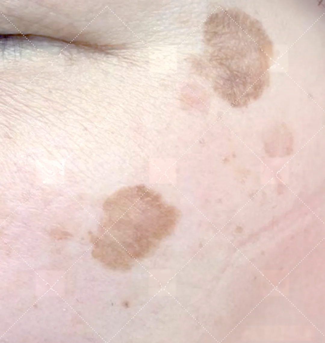 探索脸上色斑的多样类型与表现