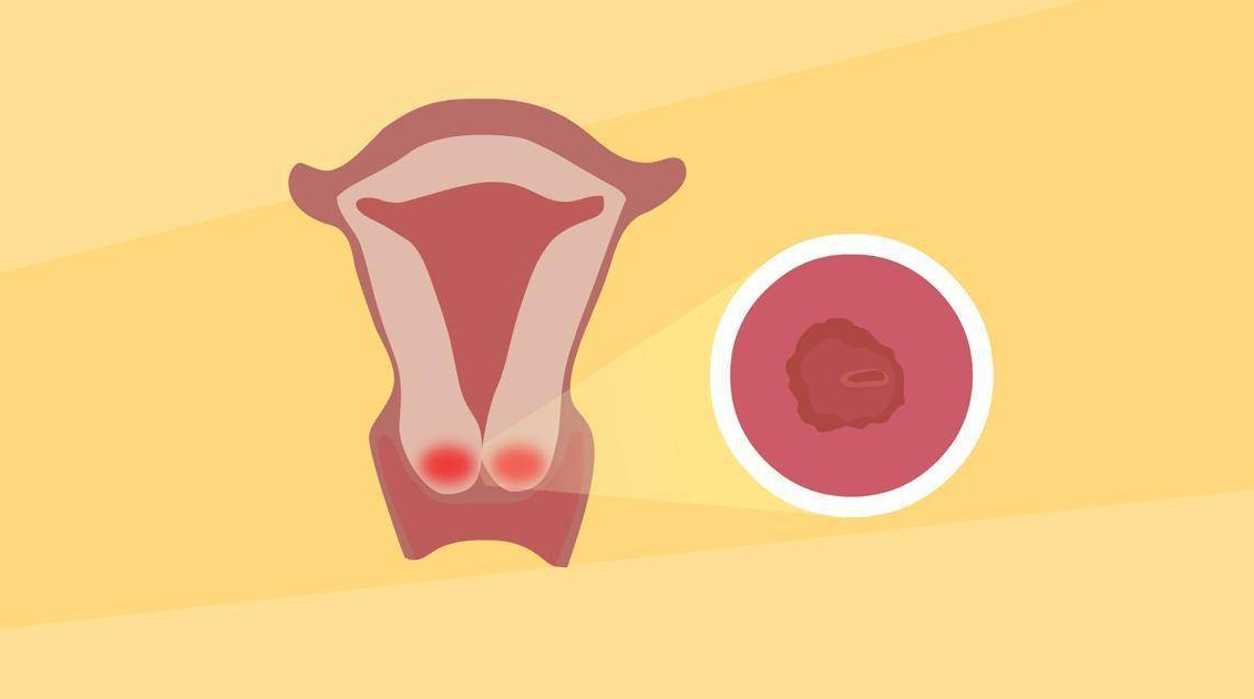 明明什么都没做过,为什么会有宫颈糜烂?别担心,这很好解决