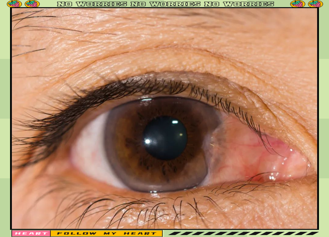 翼状胬肉:眼睛里的"赘生"组织,你了解多少?