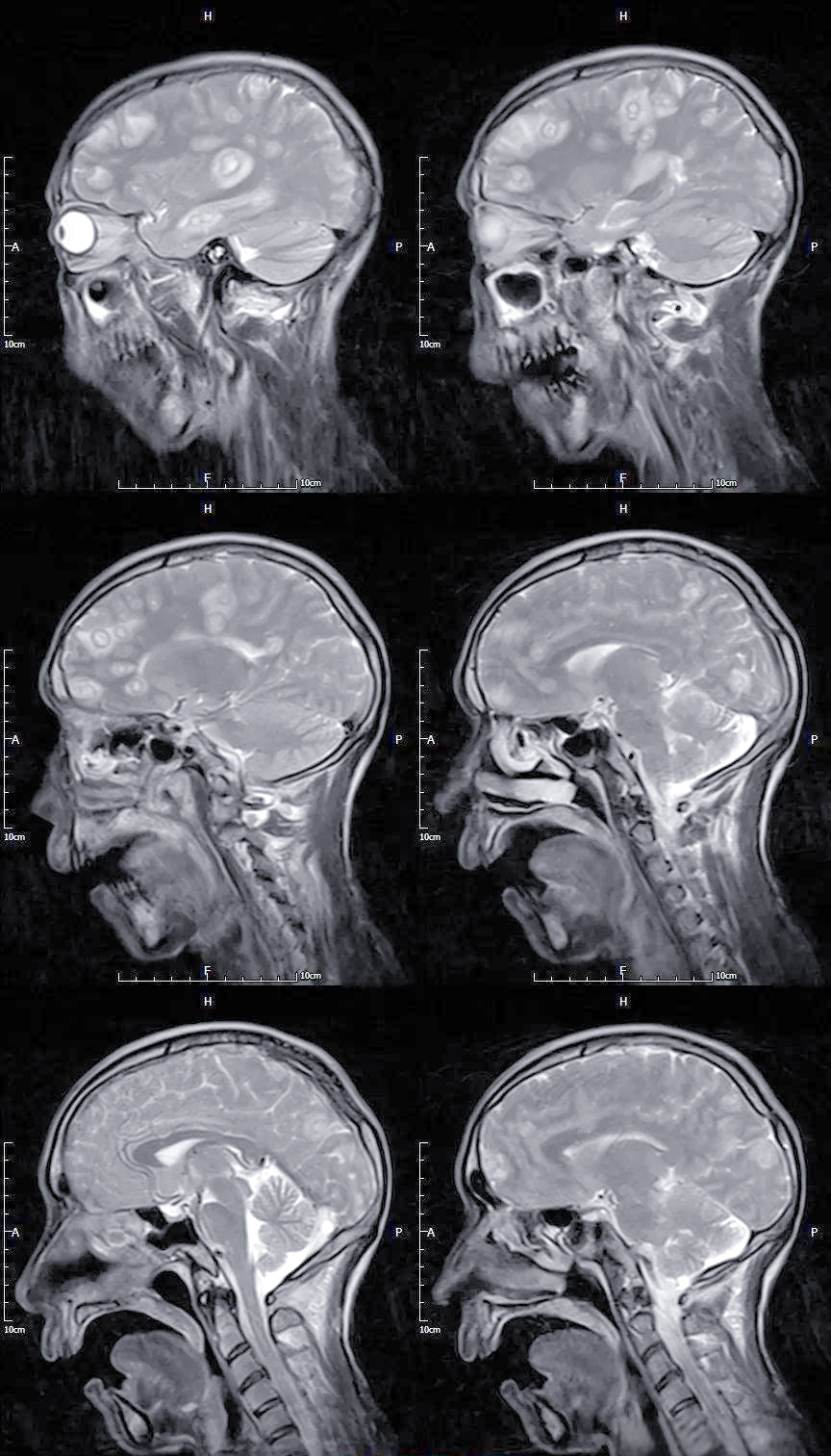 囊虫病:一种常见的中枢神经系统寄生虫感染