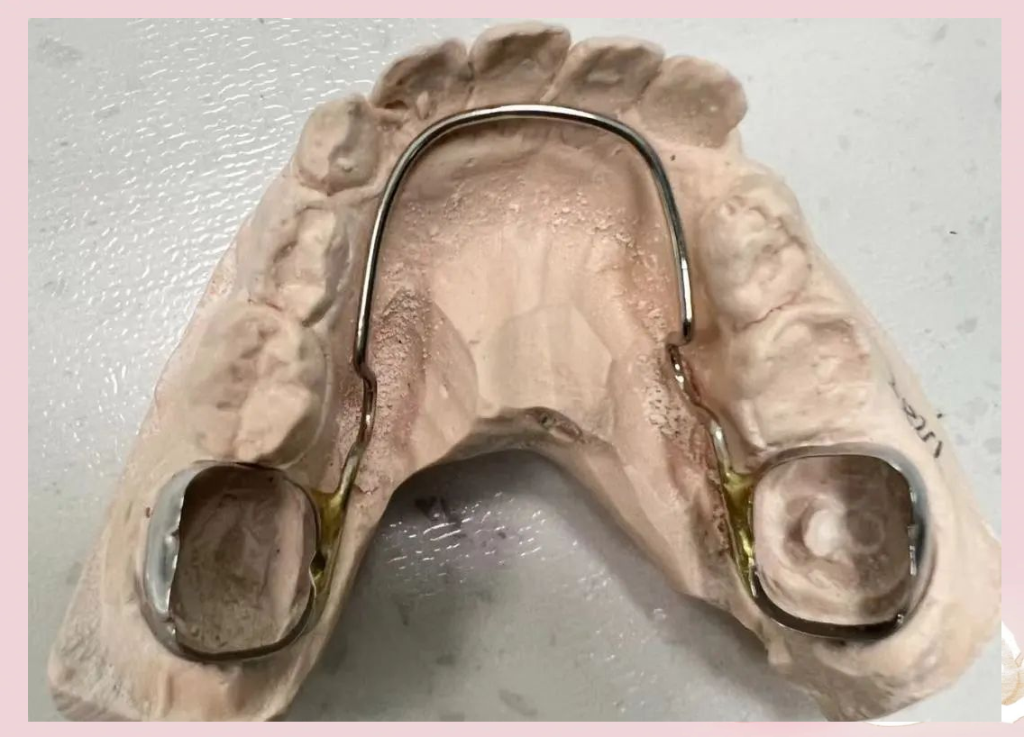 「健康科普」探索间隙保持器:为恒牙萌出保驾护航