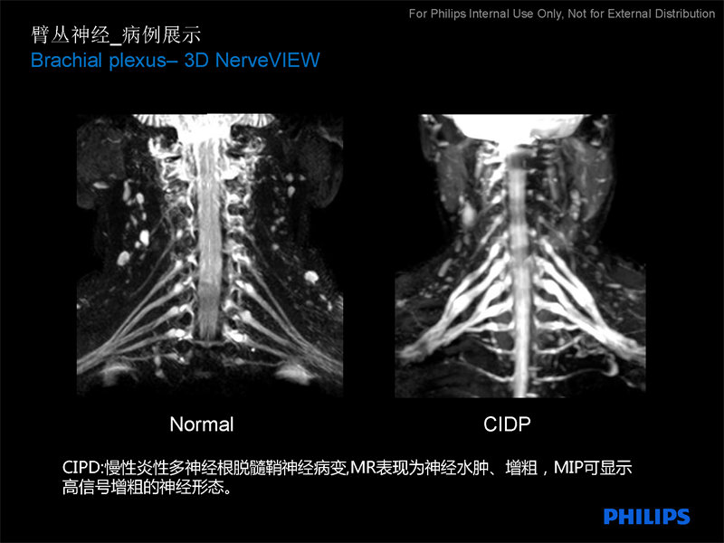 桥臂解剖MRI图片