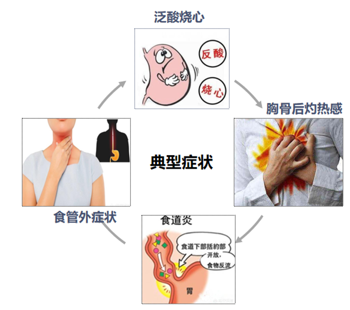 反流性食管炎分级图片