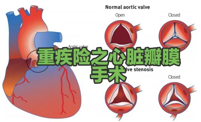 重疾险之心脏瓣膜手术