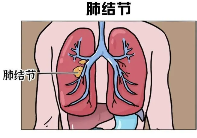 如果查出肺结节该怎么办?日常这样护理