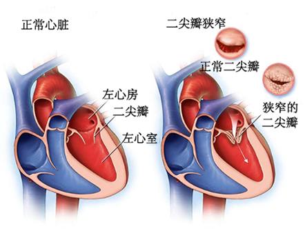 二尖瓣 成形术图片