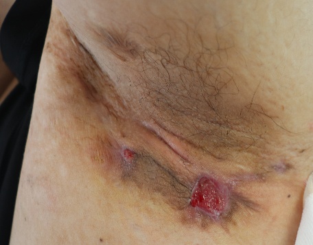 痘痘老不好,原来是因为它