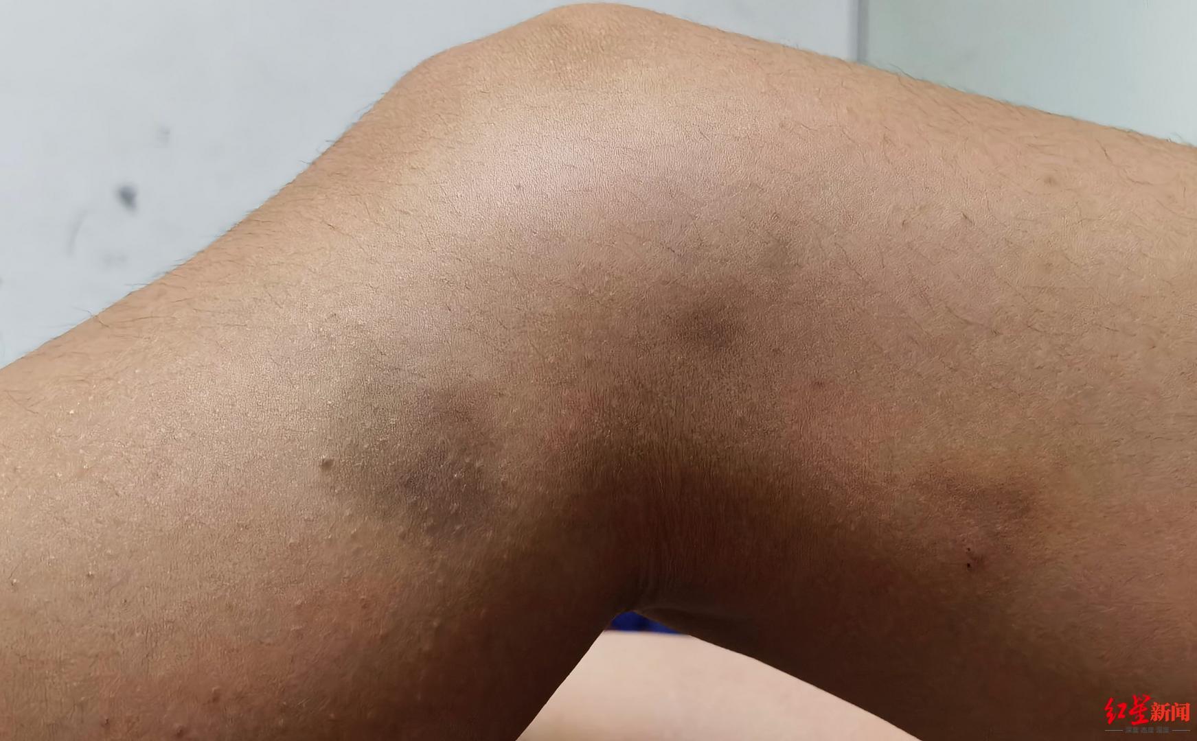 8岁女孩暑期学舞蹈被老师用鼓槌拍打多处淤青 涉事学校负责人被诫勉