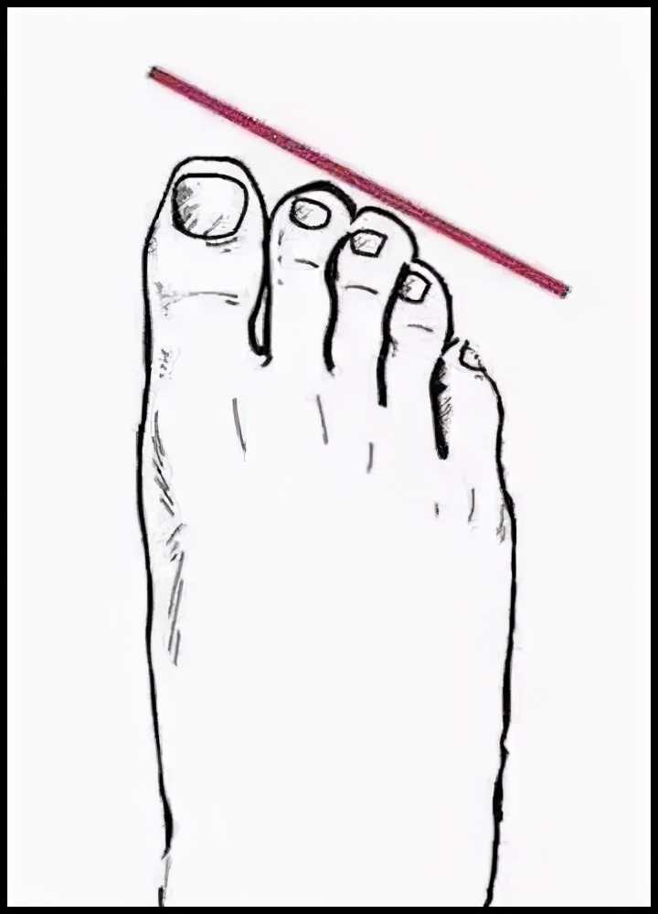 凉鞋别乱穿,先看看你的脚