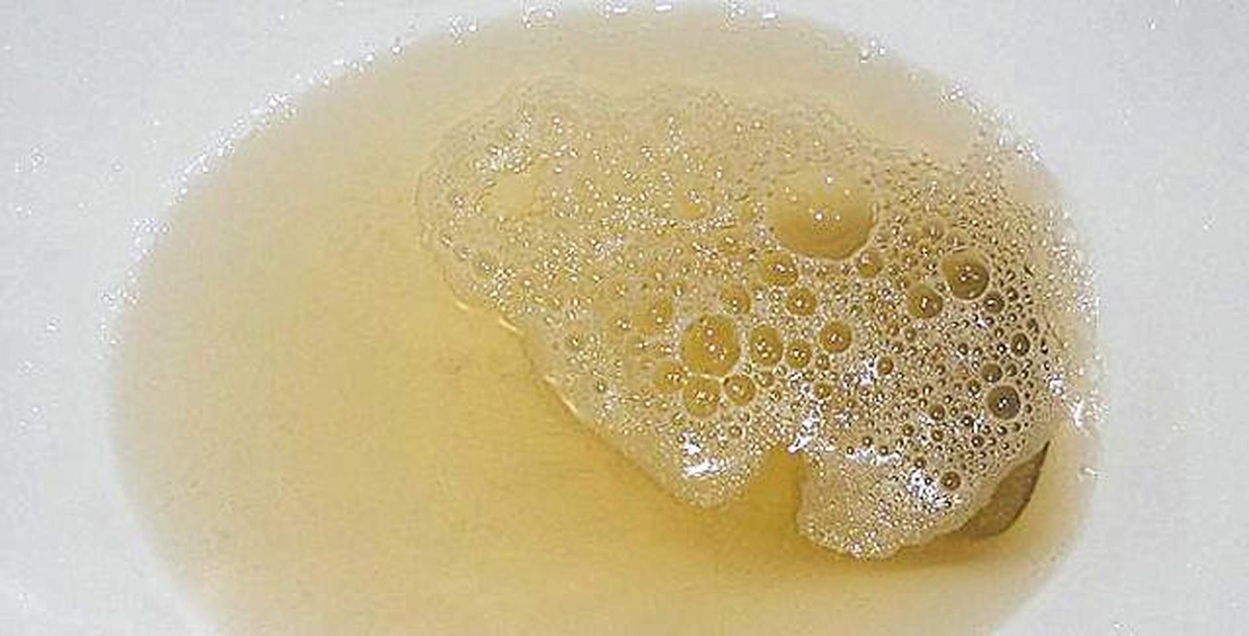 小便有泡沫说明什么问题?