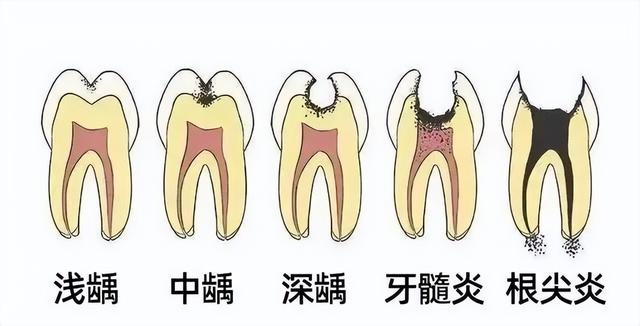 蛀牙的原因简笔画图片