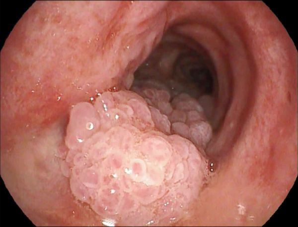 孩子不到3岁多次进手术室?只因妈妈感染hpv