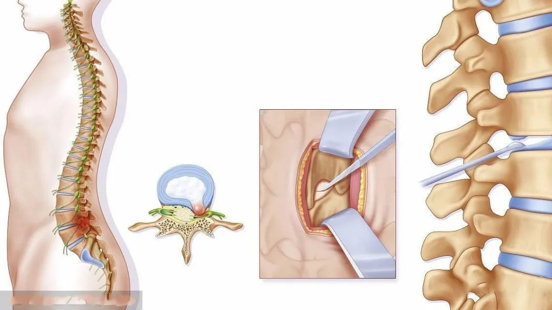 腰椎间盘突出8年,双下肢萎缩3年余,现在可以平稳行走了!