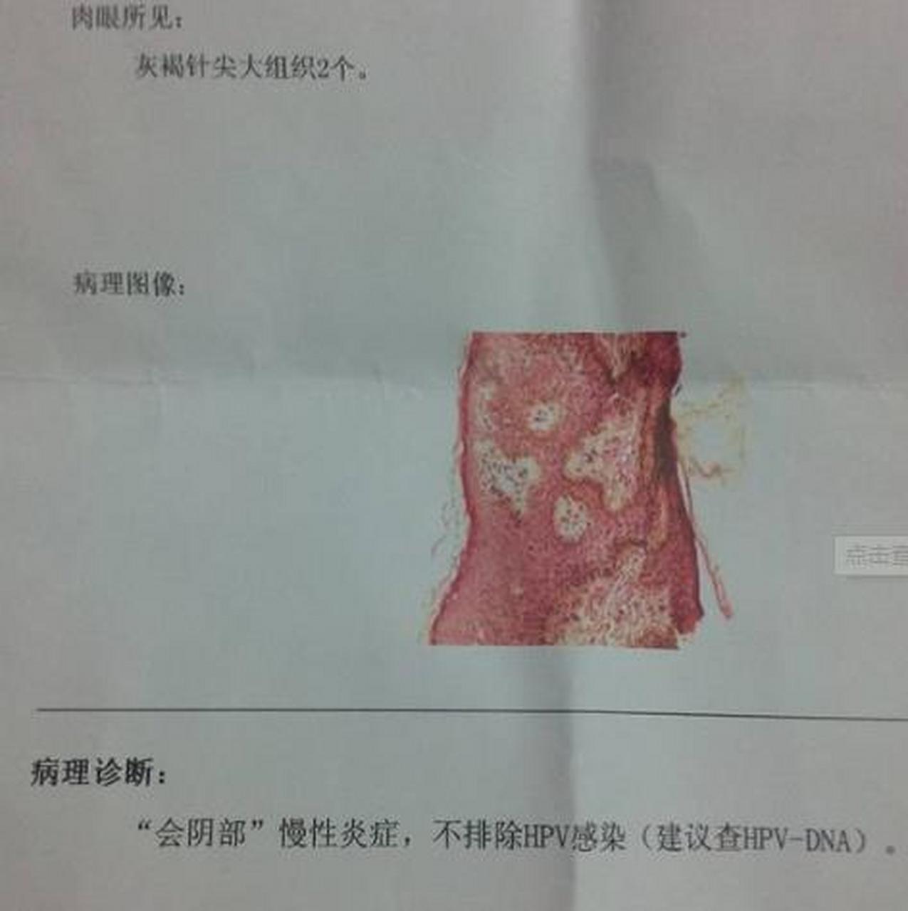 前几天我女朋友突然查出来感染了hpv,我怀疑她是不