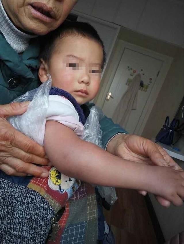 救命药买不到,难报销……14万血友病患者的用药困境