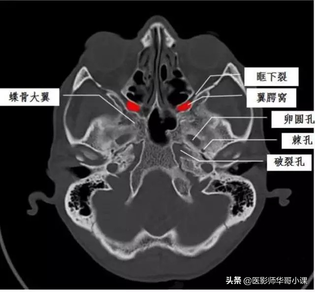 「翼腭窝ct高清图」翼腭窝的ct影像高清解剖