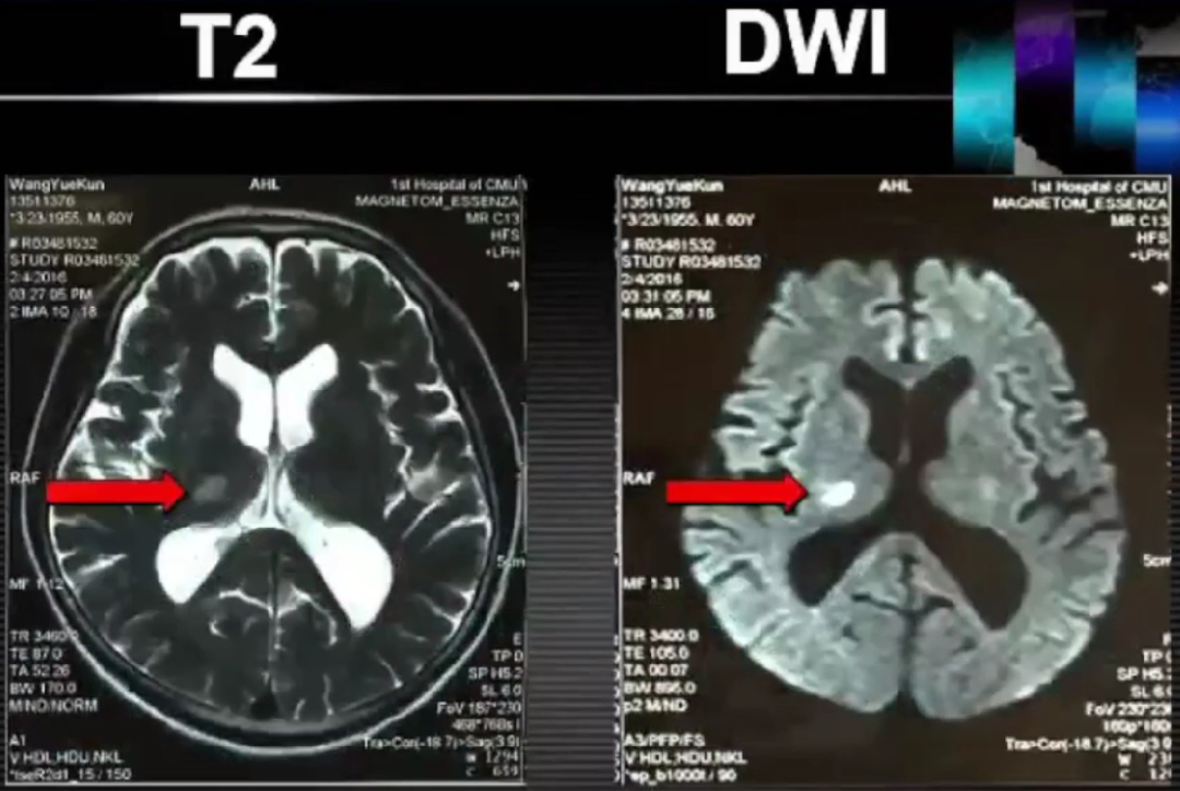 脑梗核磁图片解说图图片