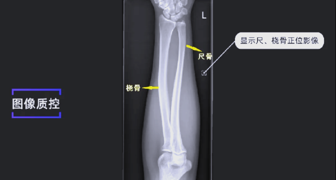 在影像探测器上,肘关节