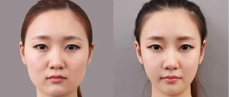 有咬肌和无咬肌的对比?