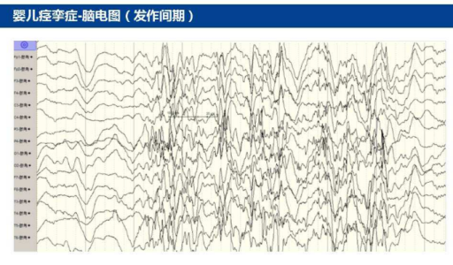 婴儿鞠躬样痉挛图片图片