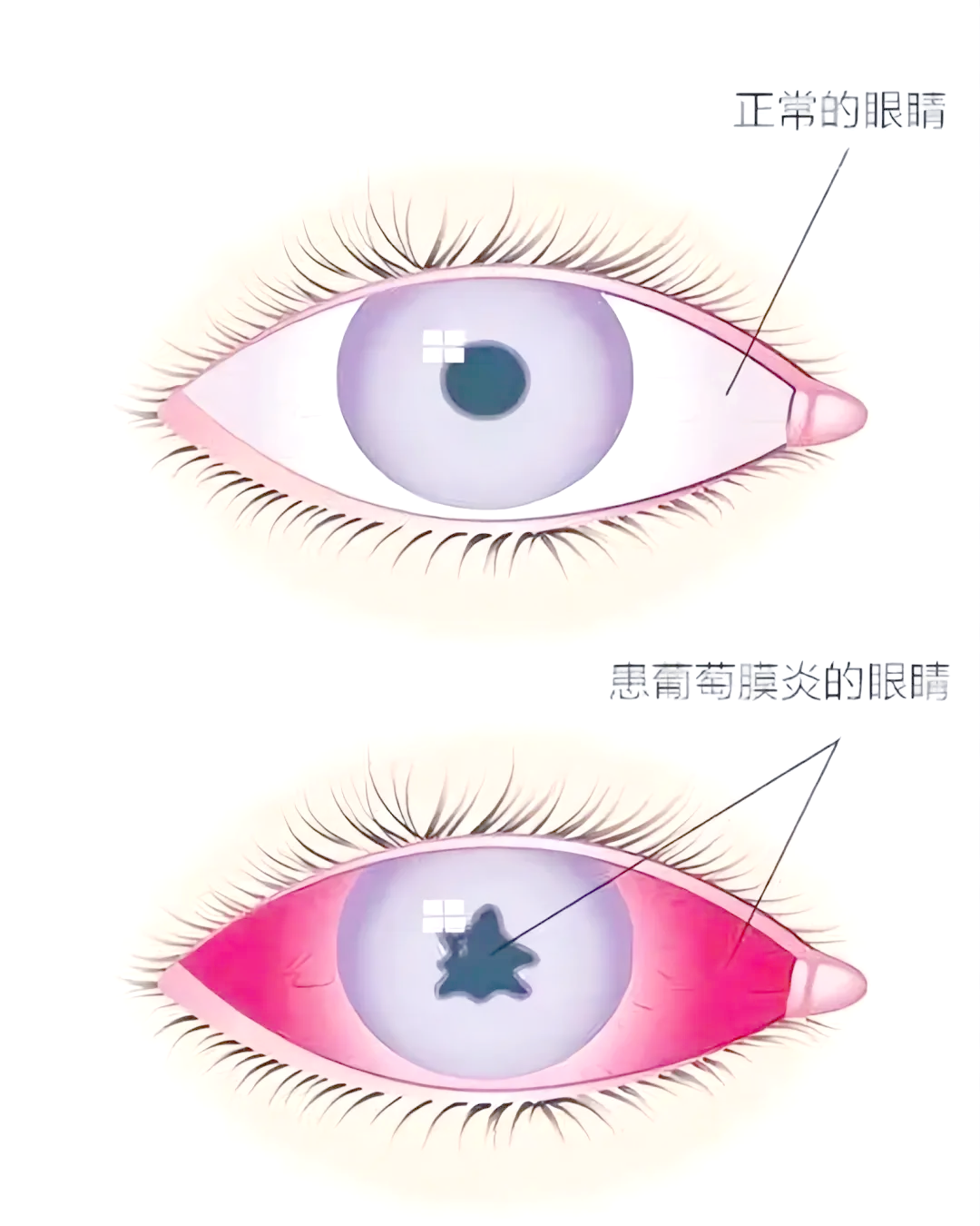 急性前葡萄膜炎,一种涉及眼睛虹膜和睫状体的炎症,其病程通常持续不