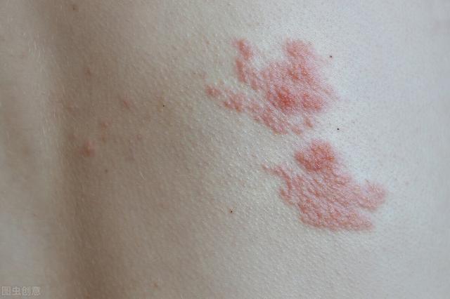 皮肤出现这4种异常,可能是癌症的信号!医生:正确区分看这3点