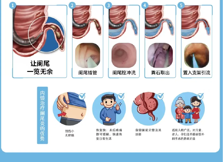 不开刀治疗阑尾炎,省医完成4岁儿童内镜下逆行阑尾炎治疗术