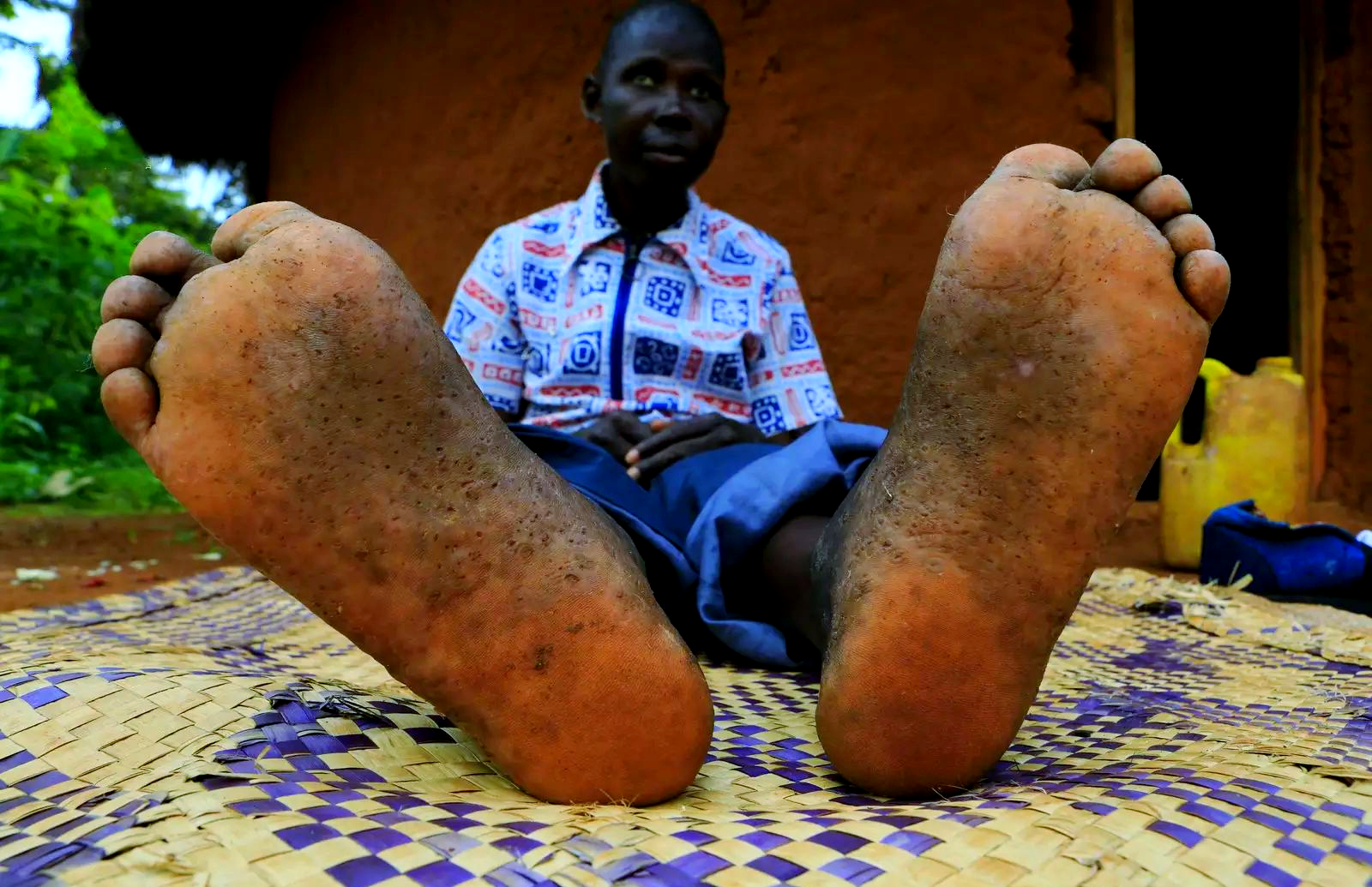 赤脚生活带来沙蚤病,非洲医疗志愿者全力救治