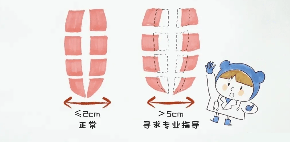 腹直肌分离检测方法图片