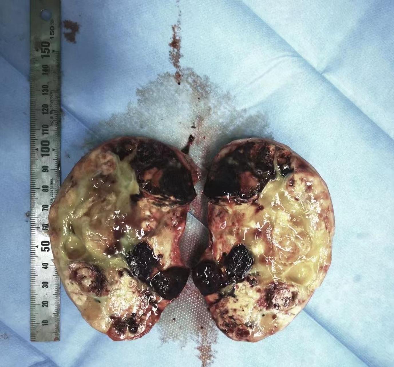 这次先做了腹腔镜下右肾肿瘤切除,先保住右侧肾脏,接下来做左肾肿瘤