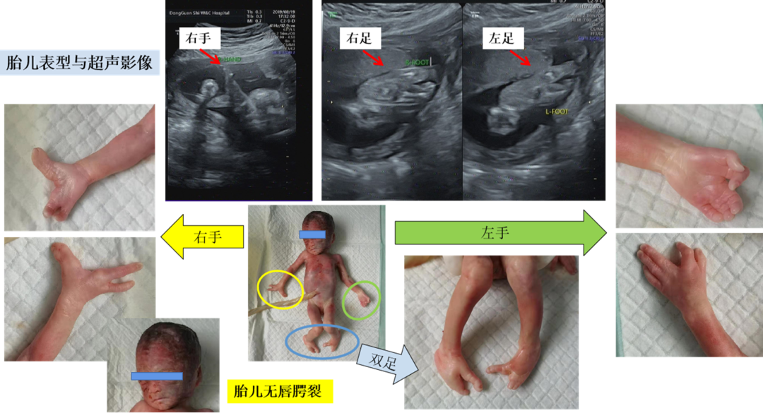 案例竞猜|23 周胎儿未遗传父亲的唇腭裂,为何还是引产了?