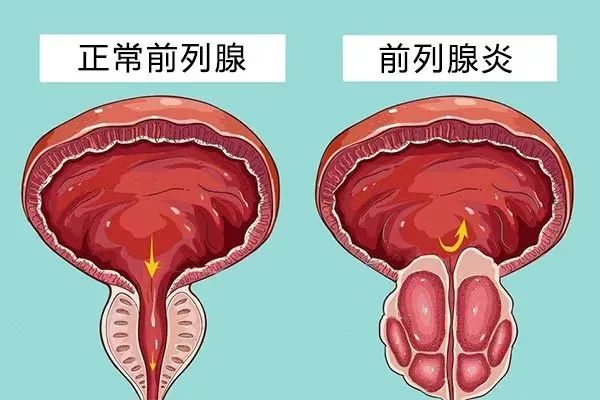 前列腺液滴白图片