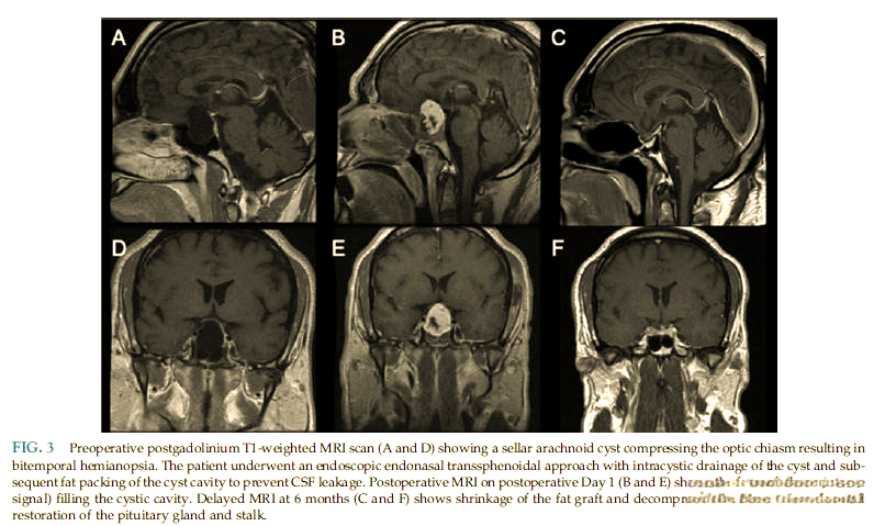 鞍区囊肿的特征,诊断与手术选择详解
