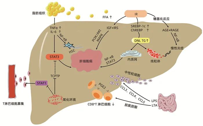 特别关注非酒精性脂肪性肝病相关肝细胞癌的发病机制与治疗