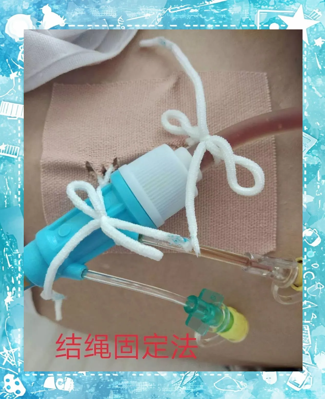 护士必备的引流管固定技巧,确保患者安全与舒适