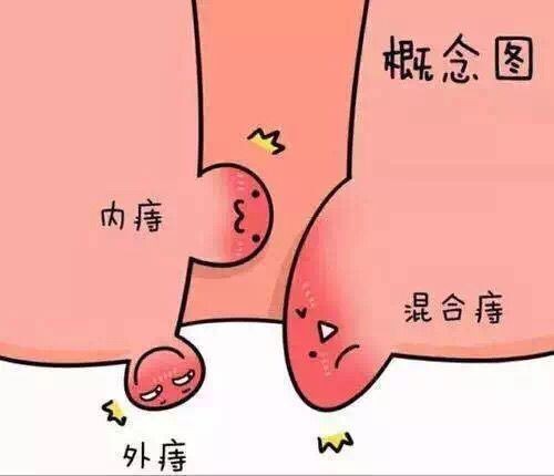 痔疮肉球图库图片