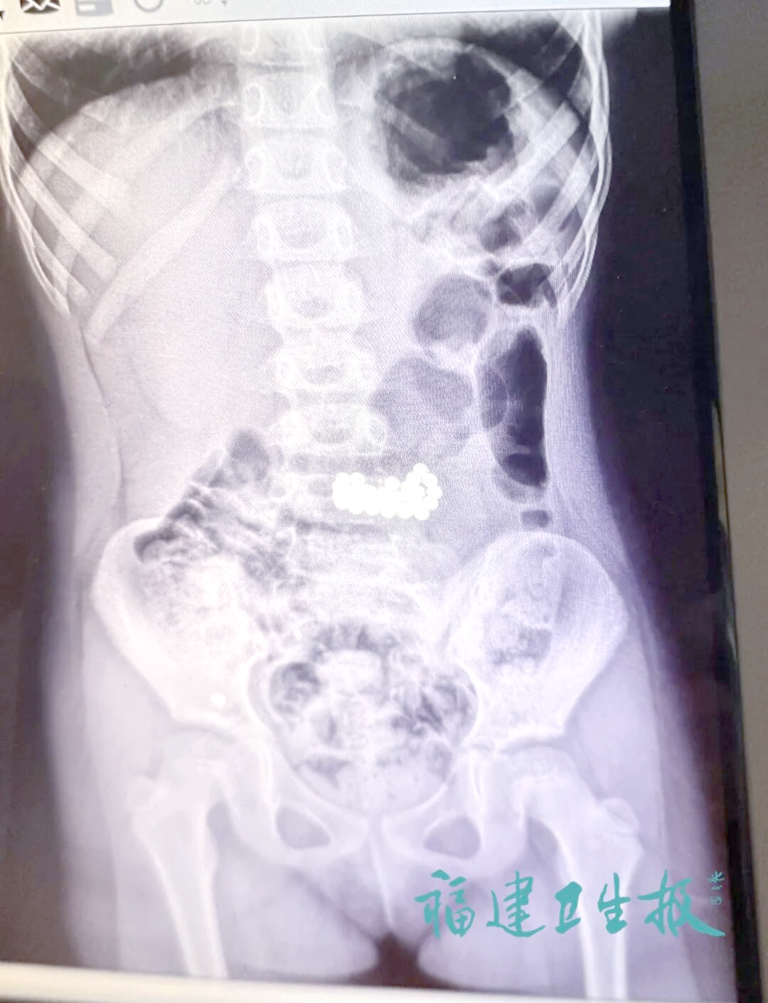 磁力珠吃到肚子里多久有反应_磁力珠吞进肚子怎么办 磁力珠吃到肚子里多久有反应_磁力珠吞进肚子怎么办 磁力珠吃到肚子里多久有反应_磁力珠吞进肚子怎么办(磁力珠吃到肚子里去了怎么办) 磁力资讯