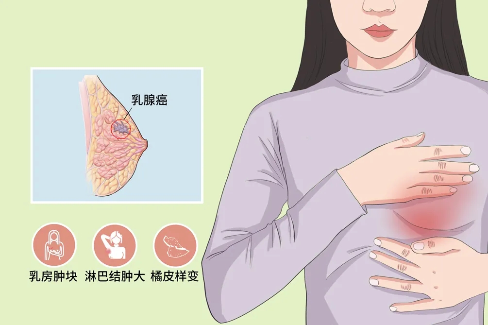 乳腺癌腋窝淋巴结肿大图片