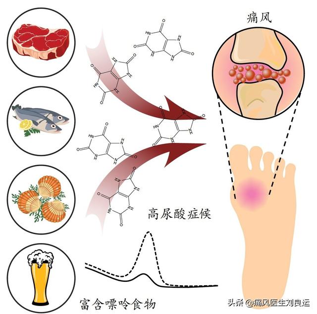 血尿酸水平正常,痛風也不發作了就是痛風治癒了嗎?醫生闢謠