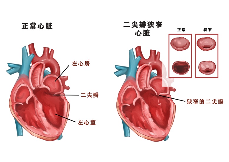 心脏瓣膜疾病 baijiahao.baidu.com