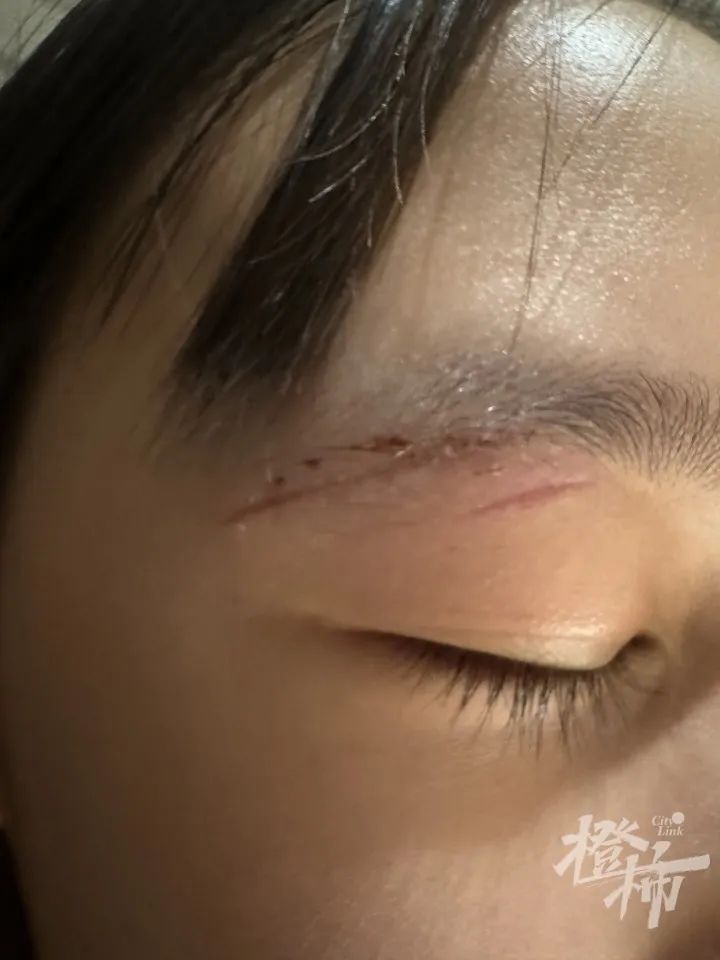 11岁女孩眼皮缝8针,差点伤到眼球
