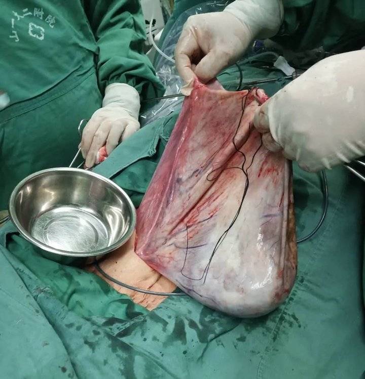 泰安63岁奶奶腹大如鼓像孕妇,医生切3cm小口高难度"拆弹"