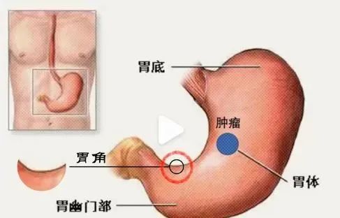 主刀医生周海洋教授:这是一个仍在持续的惨痛教训
