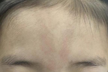 这三种"红胎记"长得很像 分不清可能会错过最佳治疗时机