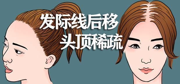 脱发治疗丨发际线后移之后,还能再长回来吗?