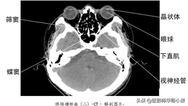 「高清ct图」头颅,胸部和腹部ct解剖图谱